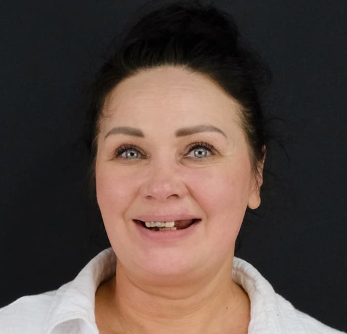 All on 6 Implants & Zirconium Crowns results, Antalya, Türkiye