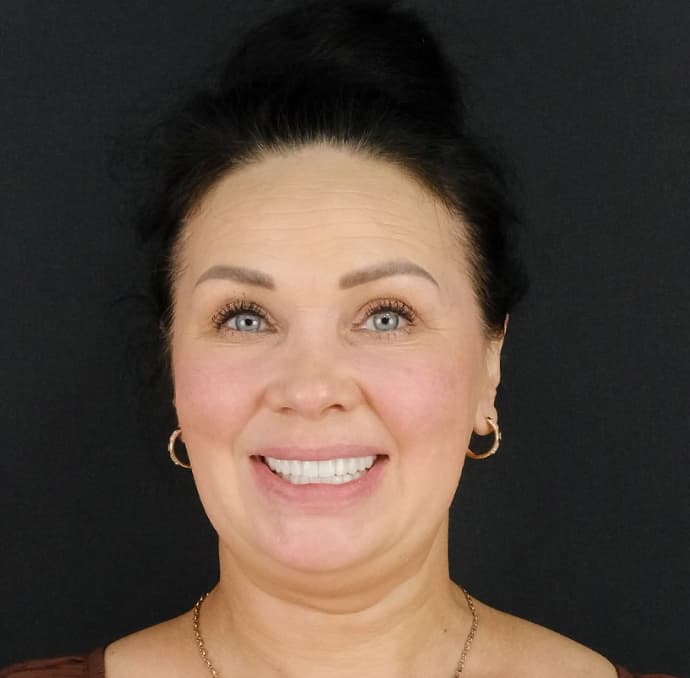 All on 6 Implants & Zirconium Crowns results, Antalya, Türkiye