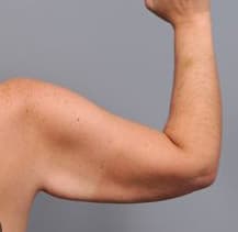 Arm Lift and Liposuction results, Antalya, Türkiye