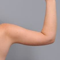Arm Lift and Liposuction results, Antalya, Türkiye