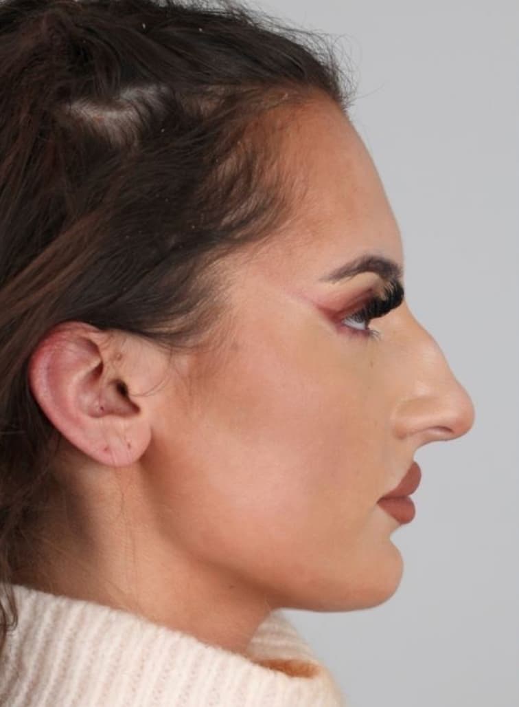 Rhinoplasty results, Antalya, Türkiye