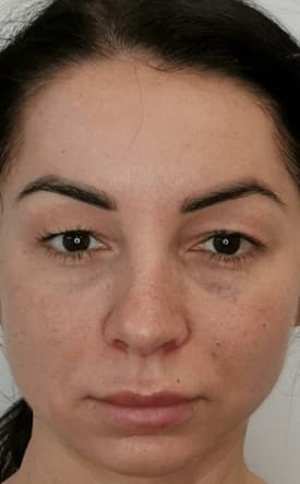 Upper Eyelids Blepharoplasty results, San Jose, Costa Rica
