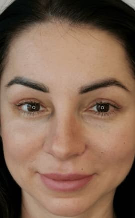 Upper Eyelids Blepharoplasty results, San Jose, Costa Rica