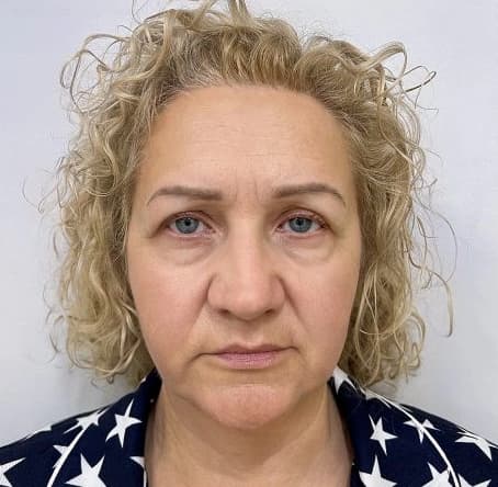 Midface Lift results, Antalya, Türkiye