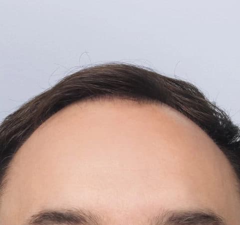 Hair Transplant results, Antalya, Türkiye