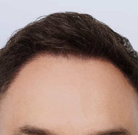 Hair Transplant results, Antalya, Türkiye