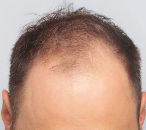 Hair Transplant results, Istanbul, Türkiye