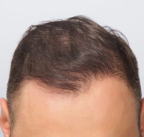 Hair Transplant results, Istanbul, Türkiye
